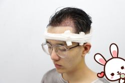 -大麦微针植发丨全国连锁