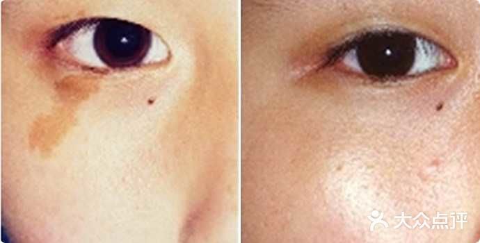 激光点痣E光祛斑 皮秒激光 激光去纹身