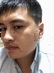 体验后-痣清宫祛斑祛痣连锁店