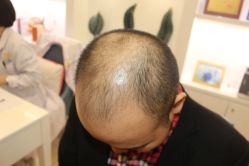 点击看大图 -大麦微针植发丨全国连锁