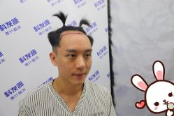 -大麦微针植发丨全国连锁