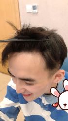 点击看大图 -大麦微针植发丨全国连锁