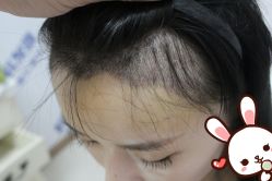 -大麦微针植发丨全国连锁