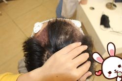 点击看大图 -大麦微针植发丨全国连锁