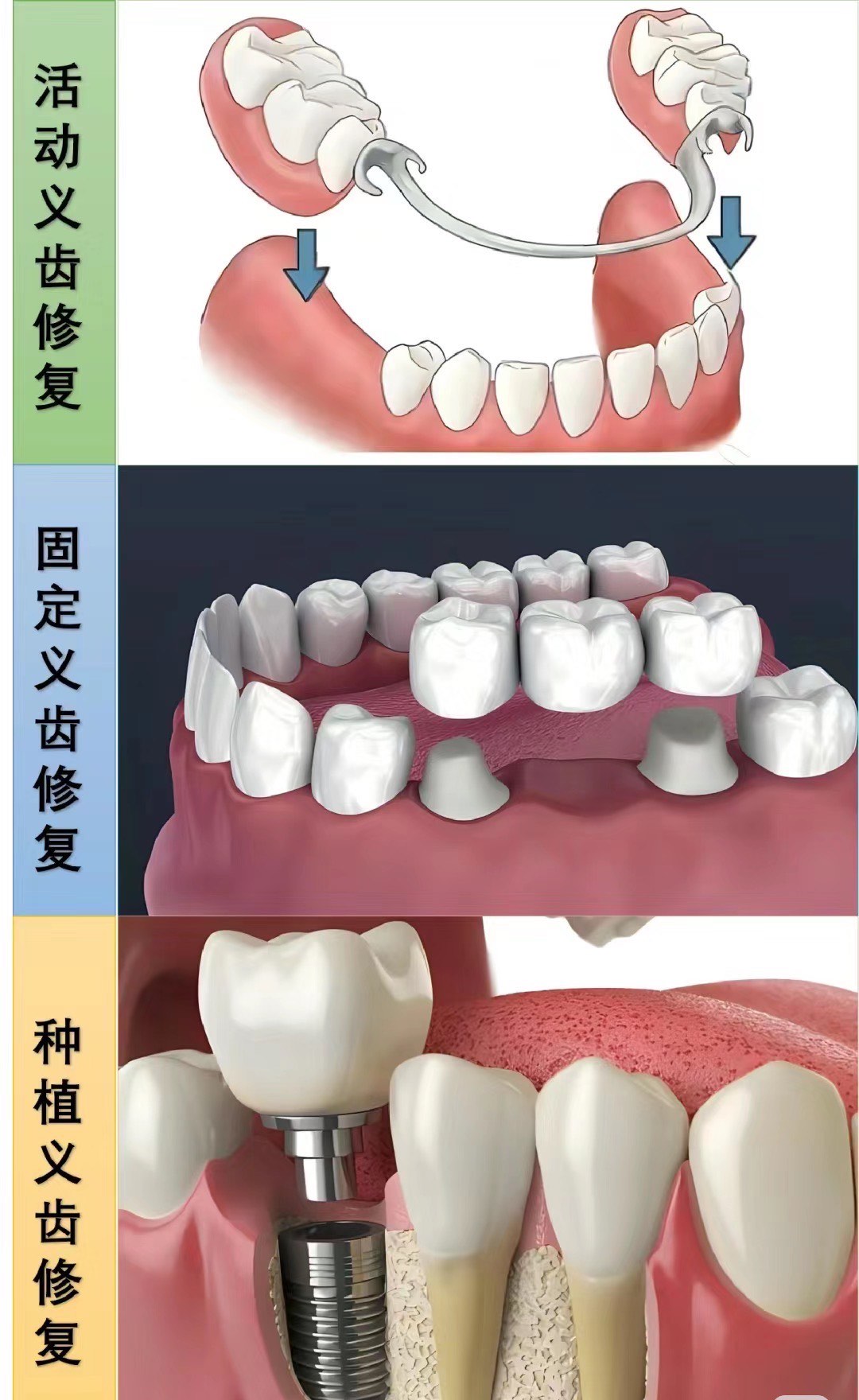 修复牙齿图片