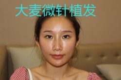 -大麦微针植发丨全国连锁