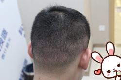 点击看大图 -大麦微针植发丨全国连锁