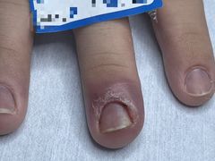 -派恩宜灰指甲(勤业店)