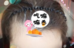 -大麦微针植发全国连锁