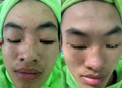 -苗医生0感祛痘连锁