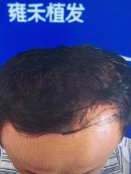 体验前-雍禾植发全国连锁