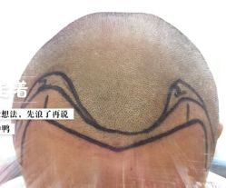 -大麦微针植发全国连锁