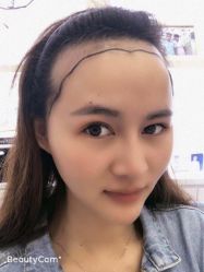 -大麦微针植发丨全国连锁