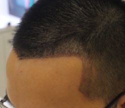 -大麦微针植发全国连锁