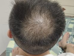 -碧莲盛·不剃发植发