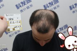 点击看大图 -大麦微针植发丨全国连锁