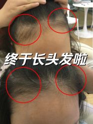 -菩叶脱发白发中心