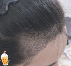 -大麦微针植发丨全国连锁