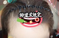 -大麦微针植发全国连锁