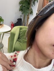 体验后-郡艺医疗美容·微整·眼鼻吸脂