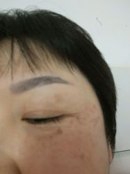 点击看大图 提斑做完第三天-北京英煌医疗美容