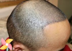 -大麦微针植发丨全国连锁