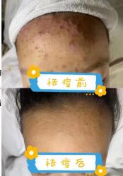 -瑶芳清颜草本祛痘