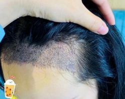 -大麦微针植发丨全国连锁