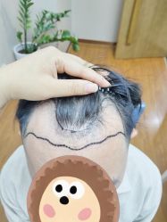 体验前-大麦微针植发全国连锁