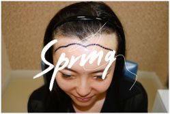 点击看大图 体验后-大麦微针植发全国连锁