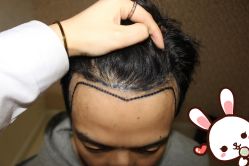 点击看大图 -大麦微针植发丨全国连锁