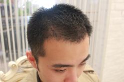 点击看大图 -大麦微针植发丨全国连锁