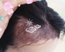 -大麦微针植发全国连锁