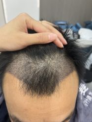 -大麦微针植发全国连锁