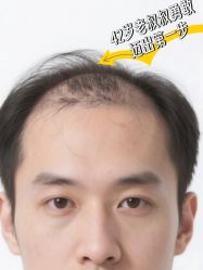 -大麦微针植发丨全国连锁