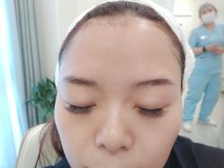 体验后-海涛医疗美容·面部抗衰·注射美鼻