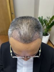 体验后-大麦微针植发全国连锁