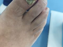 -Andrew指甲专科灰指甲·甲沟炎矫正·3D步态矫形鞋垫定制(浦三路店)