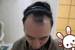 点击看大图 -大麦微针植发丨全国连锁