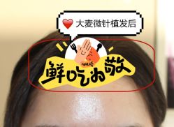 -大麦微针植发全国连锁