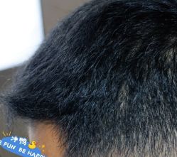 -大麦微针植发丨全国连锁