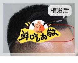 -大麦微针植发全国连锁