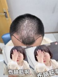 -大麦微针植发丨全国连锁