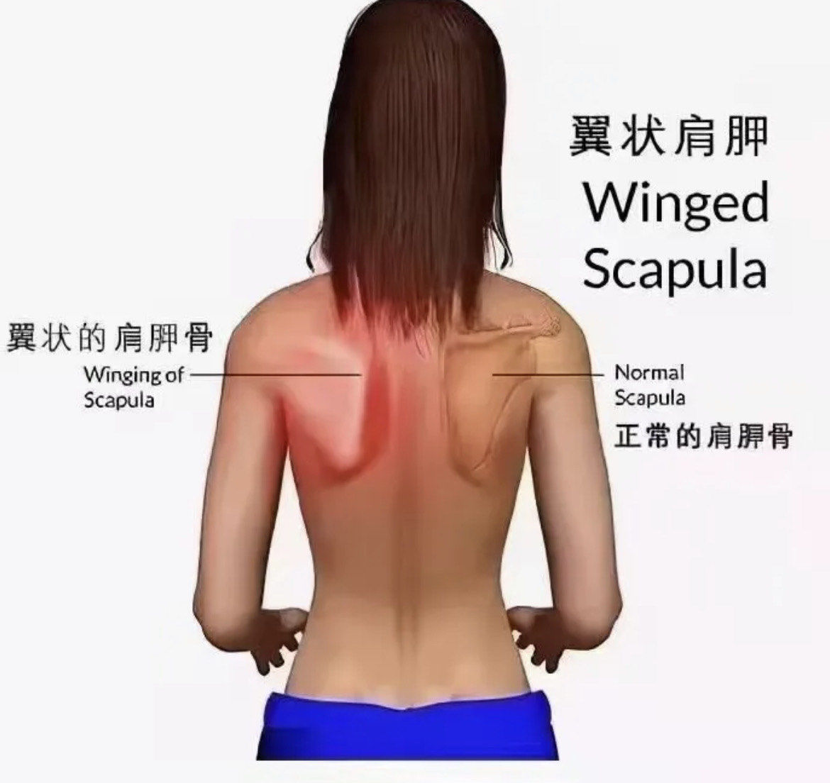 性感的"蝴蝶骨背"其实是一种病!
