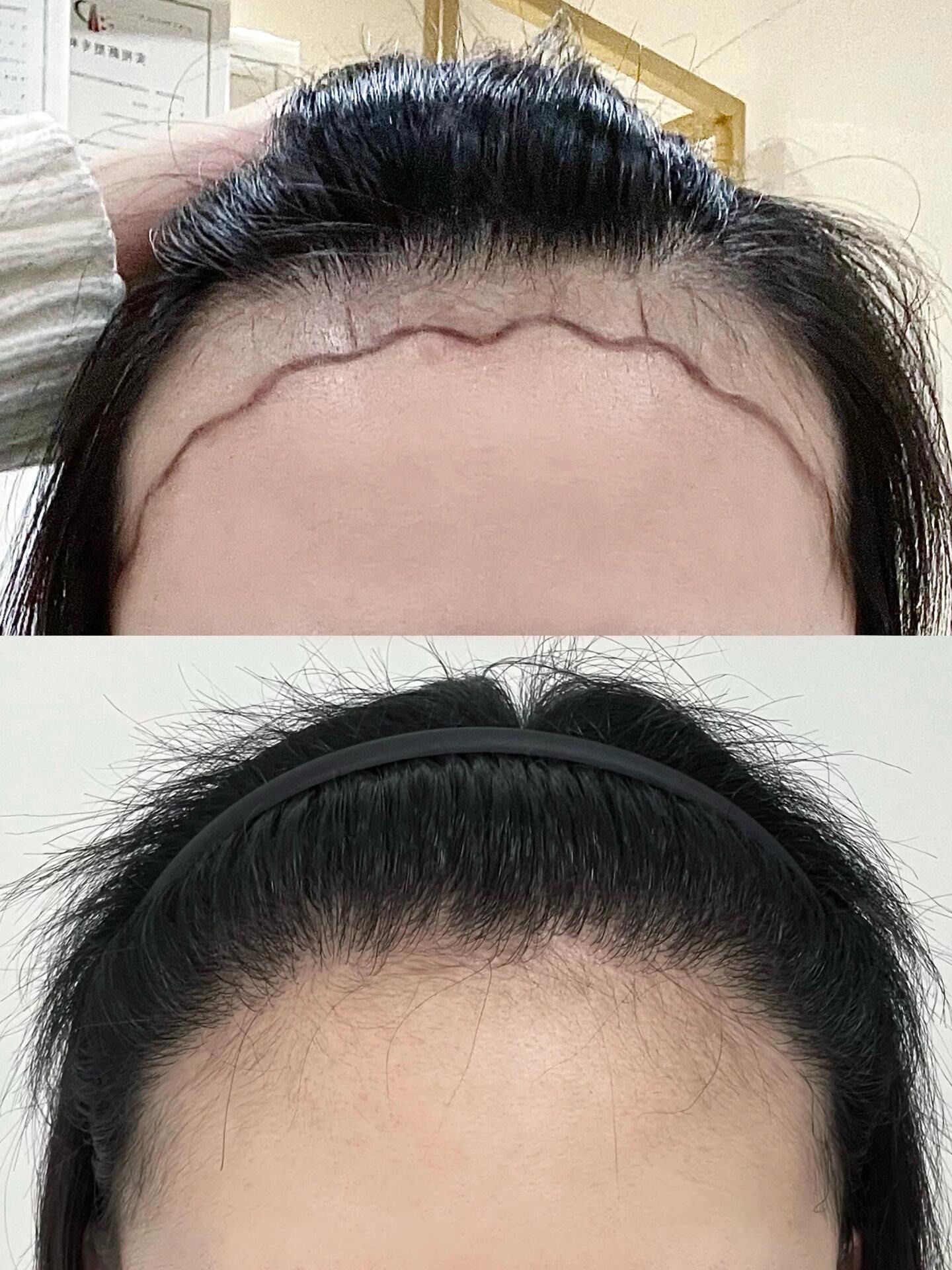 植发| 前后对比 谁的假头套落我脑袋上啦