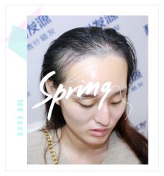 体验后-大麦微针植发全国连锁