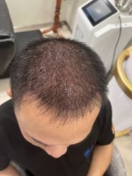 体验后-碧莲盛·不剃发植发