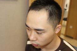 -大麦微针植发丨全国连锁