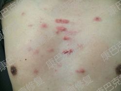 -康巴克疤痕修复连锁机构