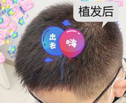 -大麦微针植发全国连锁